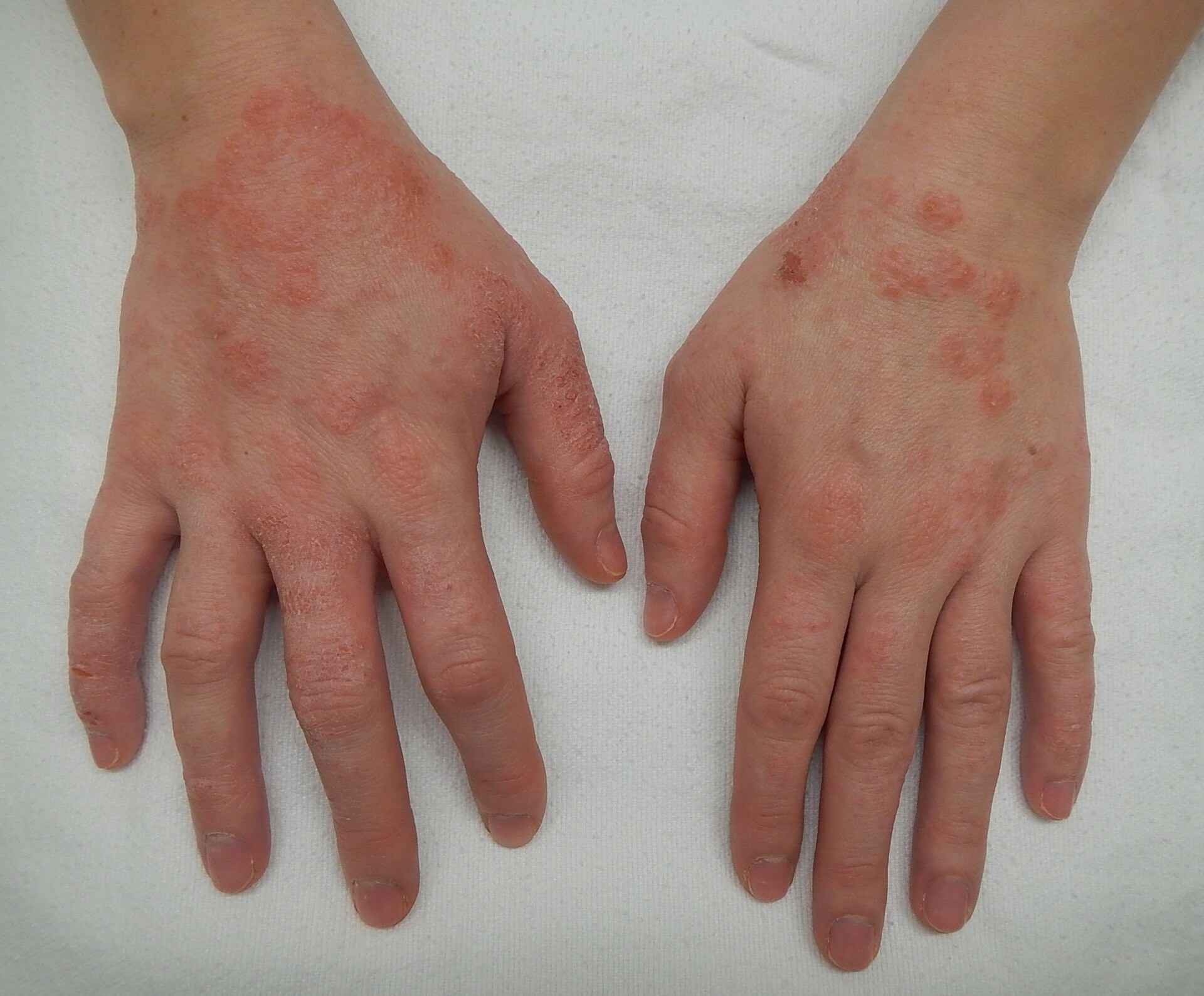 Close-up photo of an inflamed, itchy skin rash with redness