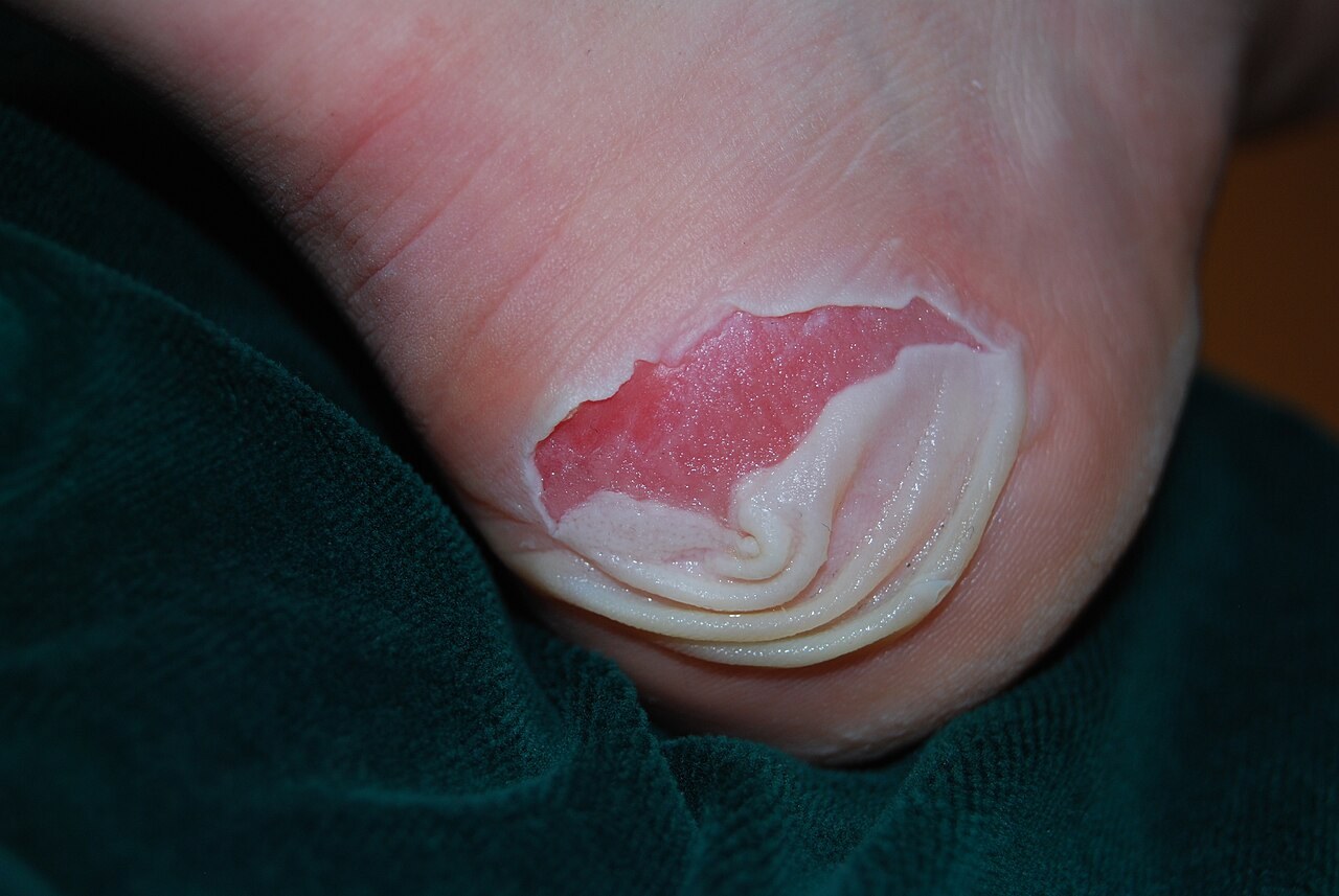 Friction blister on the heel caused by rubbing shoes